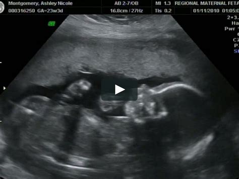 23 week ultrasound on Vimeo