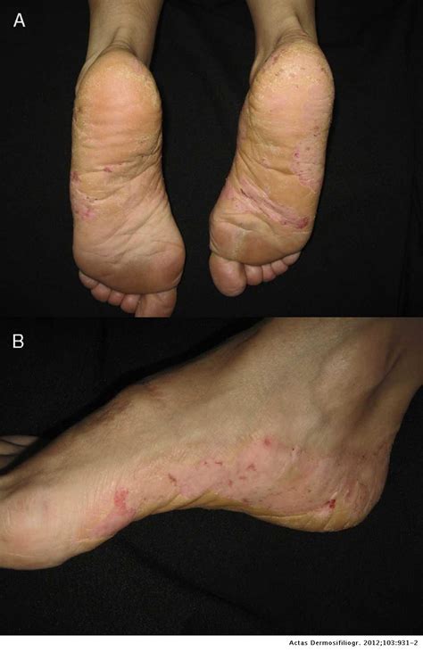 Successful Treatment of Recalcitrant Chronic Foot Eczema with ...