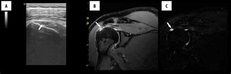 A Usg Showing Grade I Full Thickness Tear Of Supraspinatus Tendon ...