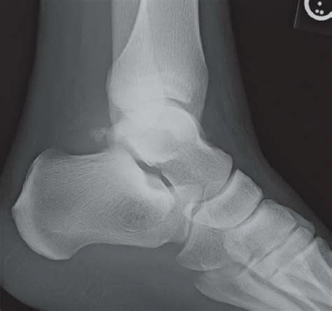 Lateral Process of Talus Fracture | Radiology Key