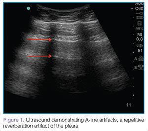 Emergency Ultrasound: Lung Assessment | MDedge Emergency Medicine