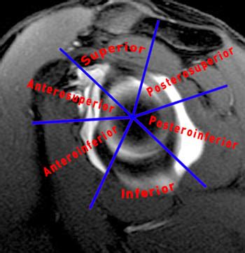 MRI Musculo-Skeletal Section: Labrum