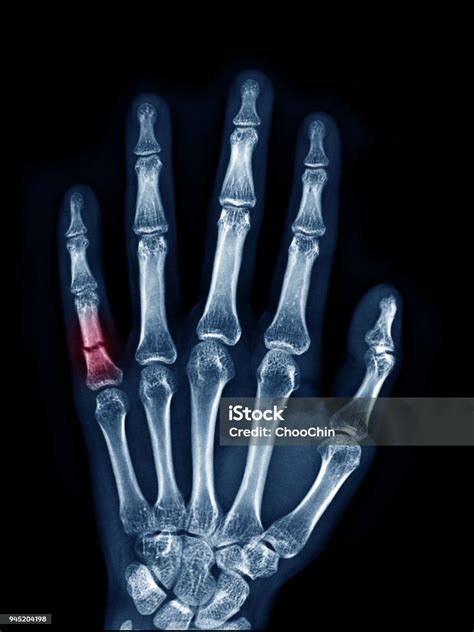 Xray Image Of Left Hand Show Fracture At Little Finger Upper View Area ...