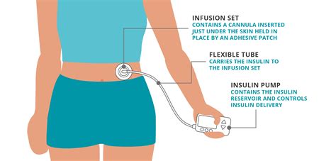 Insulin Pumps: Types & How They Work | Omnipod UK!