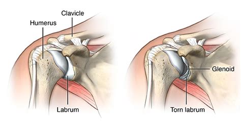 Subluxation shoulder joint - Blog | Axis Orthopedic Hospital : Blog ...