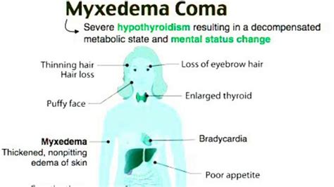 Myxedema Coma - A Medical Emergency! - MEDizzy