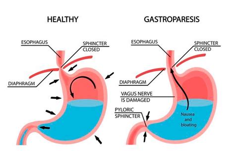 Hablemos sobre la Gastroparesia ️