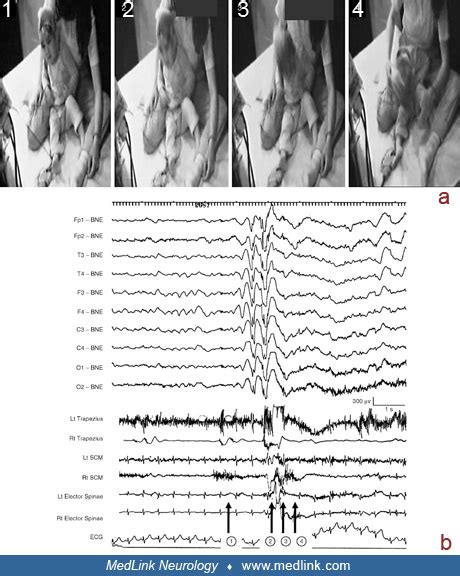 Myoclonic-atonic seizure in a 2-year-old boy (video-EEG) | MedLink ...