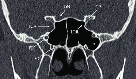 Coronal CT scan at the level of sphenoid sinus showing the critical ...