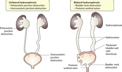 Kidney and urinary tract disorders | Obgyn Key