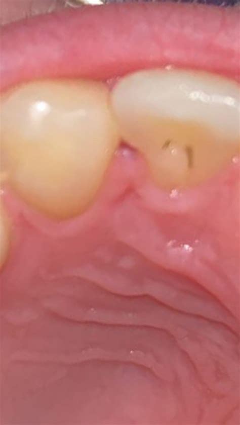 Gum cyst? : r/askdentists