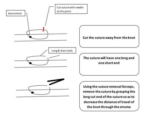 Corneal Suture Removal - Eyedocs