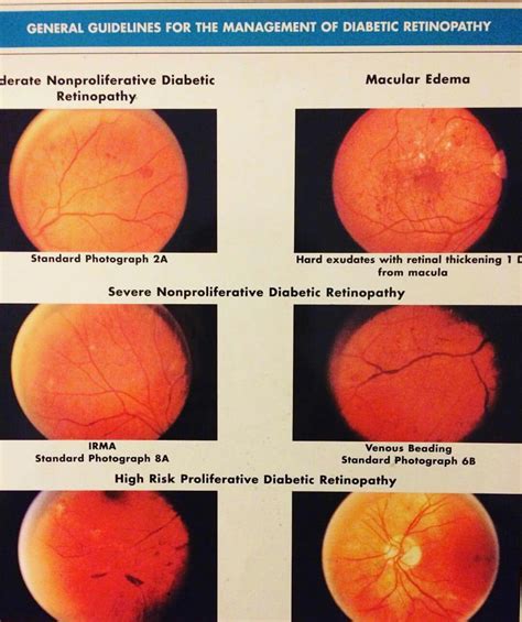 Diabetic Retinopathy stages Diabetic Retinopathy Stages, Optician ...