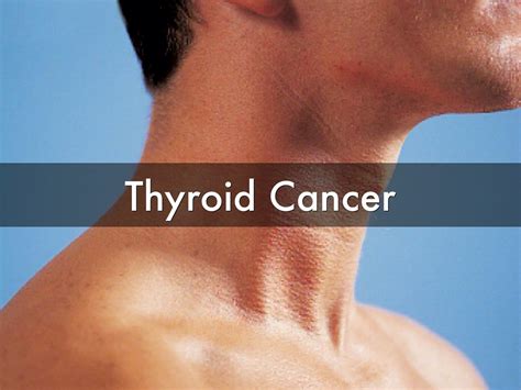 Thyroid Cancer - Types - Signs, Symptoms, Stages & Treatment