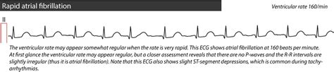 Atrial fibrillation: ECG, classification, causes, risk factors ...