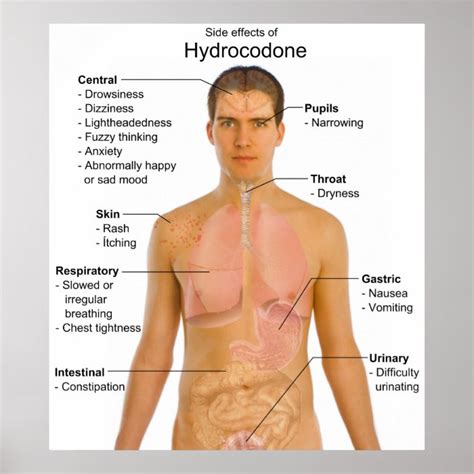 Chart of the Side Effects of Opioid Hydrocodone Poster | Zazzle