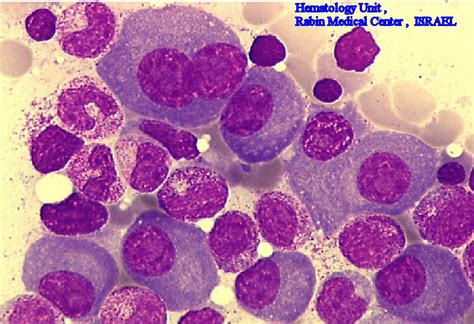 All About HIM: ): Lets talk about Plasma Cell Disorders