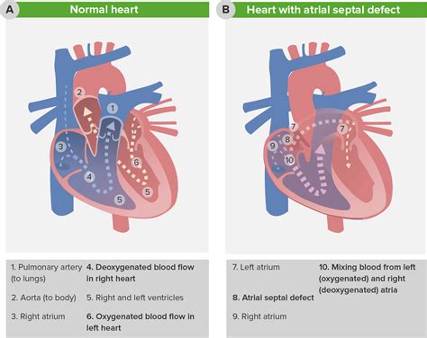 Atrial Septal Defect Surgery