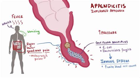 Peritonitis: What is it, Causes, Diagnosis, Treatment, and More | Osmosis