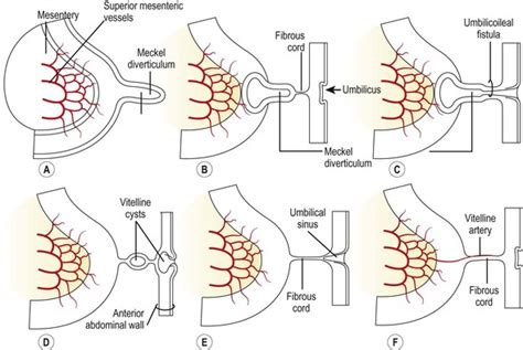 Diverticulum Types