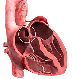 Atrial Septal Defect Symptoms