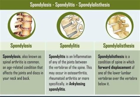 Spondylolysis Vs Spondylolisthesis