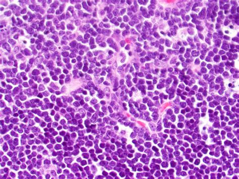 Acute Lymphoblastic Leukemia Bone Marrow Biopsy