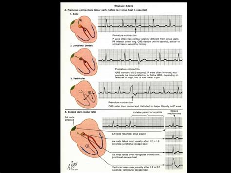 Ecg En Arritmias