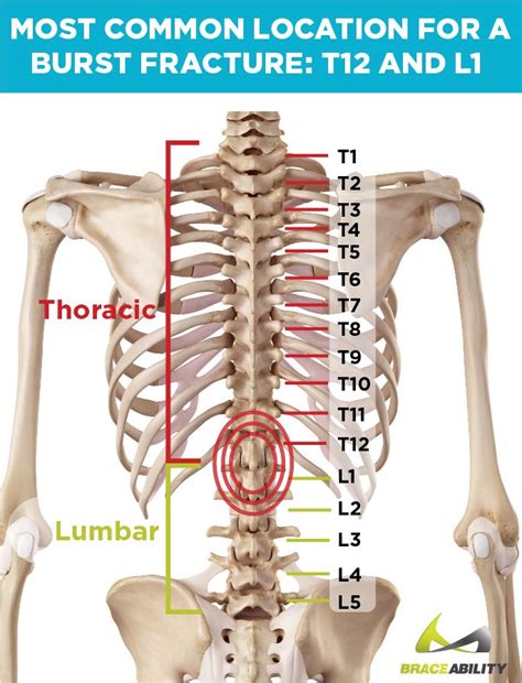 L1 Vertebrae Fracture