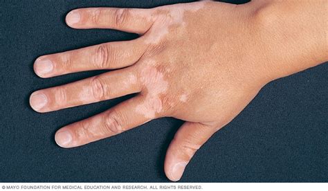 Vitiligo - Symptoms and causes - Mayo Clinic