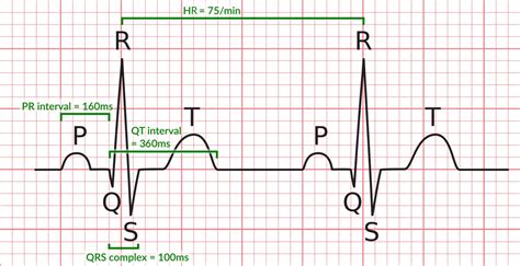 Qrs Wave On Ekg