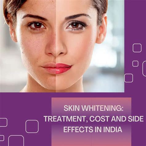 Skin Whitening: Treatment, Cost And Side Effects In India