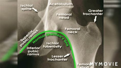 Shenton's line| orthopedics| hip joint #hipfracture # ...