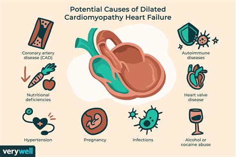 Dilated Cardiomyopathy Symptoms, Causes, Diagnosis, and Treatment