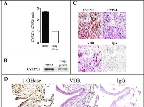 Expression of 1?-hydroxylase (1-OHase) in mesothelioma and normal ...