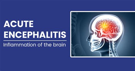 Acute encephalitis - Causes, Symptoms, Diagnosis and Treatments