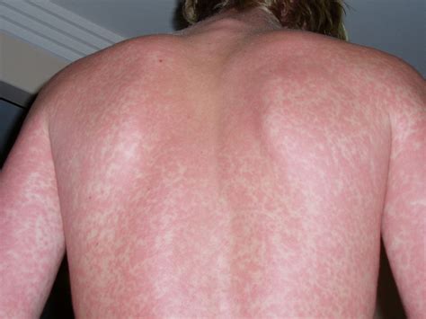 Itchy Rash | Healthtipsandguides.net