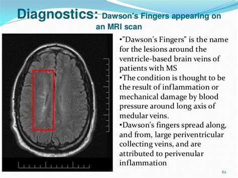 Multiple Sclerosis Research: MRI: can you teach an old dog new tricks?