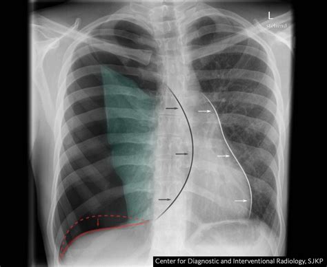 Left Pneumothorax X Ray