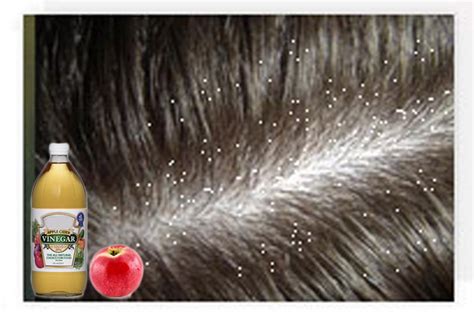 Divalicious: 20 Home Remedies to Get Rid of Dandruff- Dandruff ...