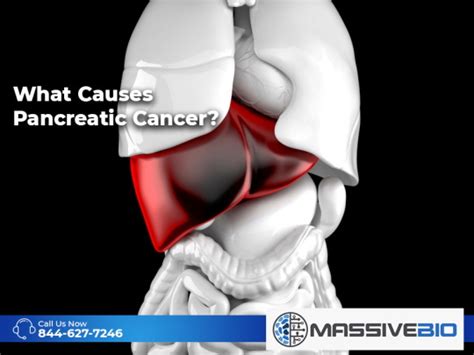 What Causes Pancreatic Cancer