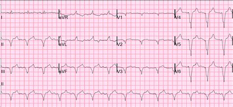 Dr. Smith's ECG Blog: Paced rhythm, Modified Sgarbossa negative, but ...