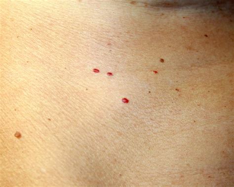 What causes red blood spots on my skin? - Quora