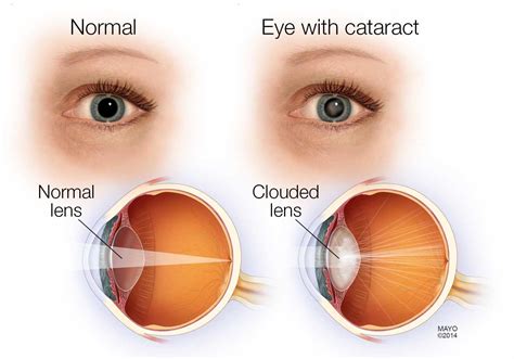 Curing Cataracts without Surgery? - Mayo Clinic News Network