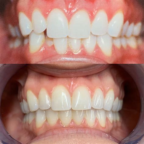 Invisalign Before And After | Firouz Orthodontics - West Los Angeles