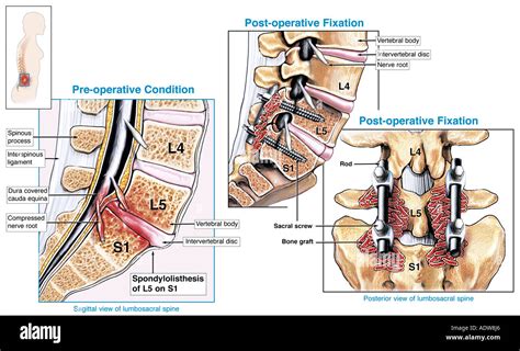 Lumbar Spondylolisthesis Surgery