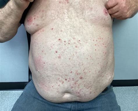 Clinical Challenge: Red Itchy Rash on Chest - MPR