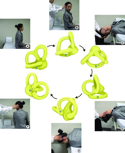 Epley Maneuver For Right Benign Paroxysmal Positional Vertigo Arising ...