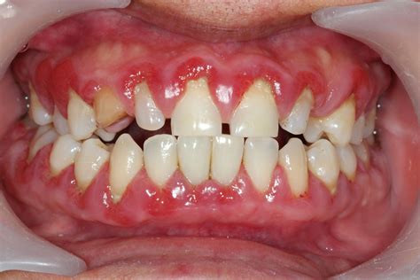 Causes Of Infection In Gums at William Conover blog