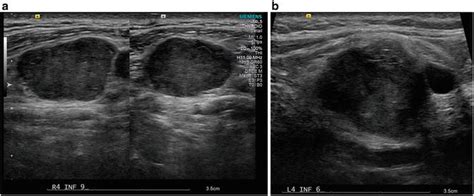 Abnormal Cervical Lymph Node Ultrasound